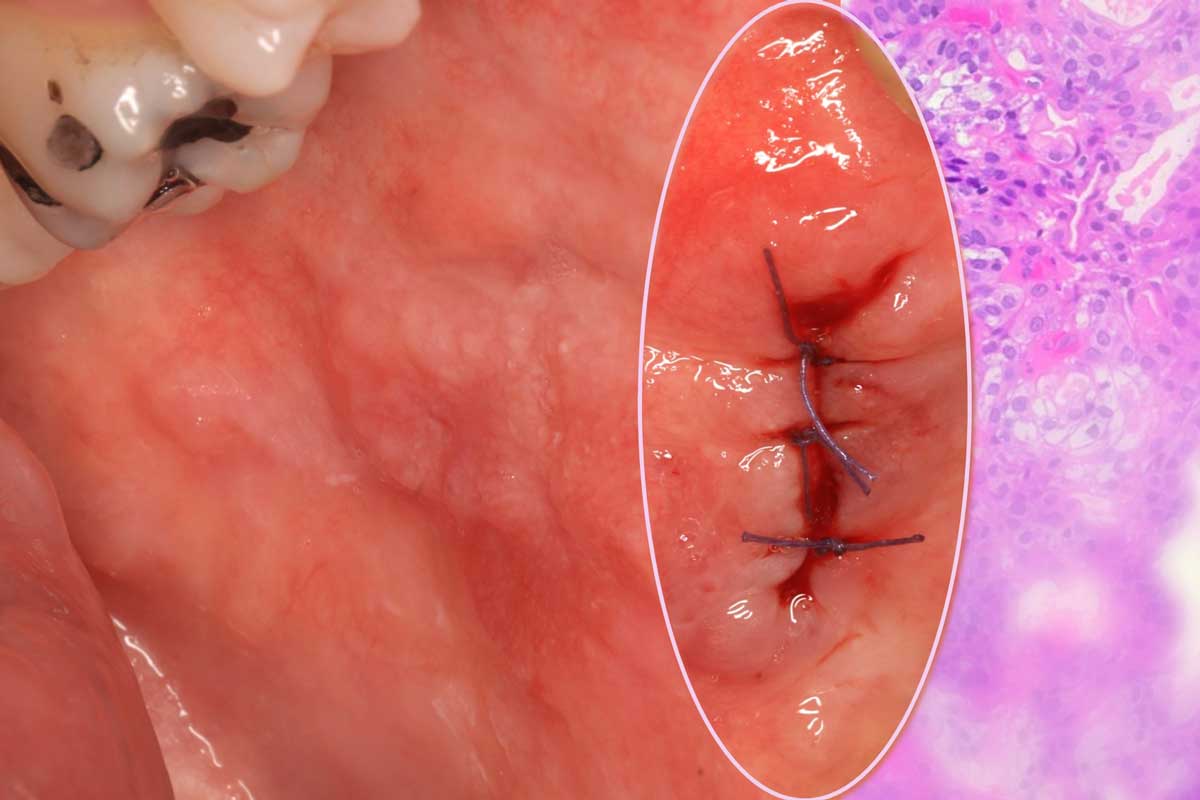 Intraoral lesion and a wound of a biopsy taken; on the right, a histopathological image