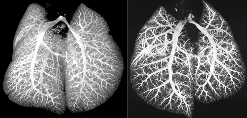 Healthy lung vasculature with adequate branching and diseased lung vasculature with rarified vessel branching