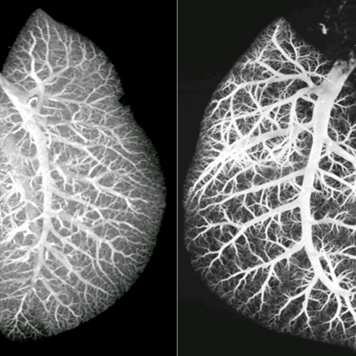 Healthy lung vasculature with adequate branching and diseased lung vasculature with rarified vessel branching